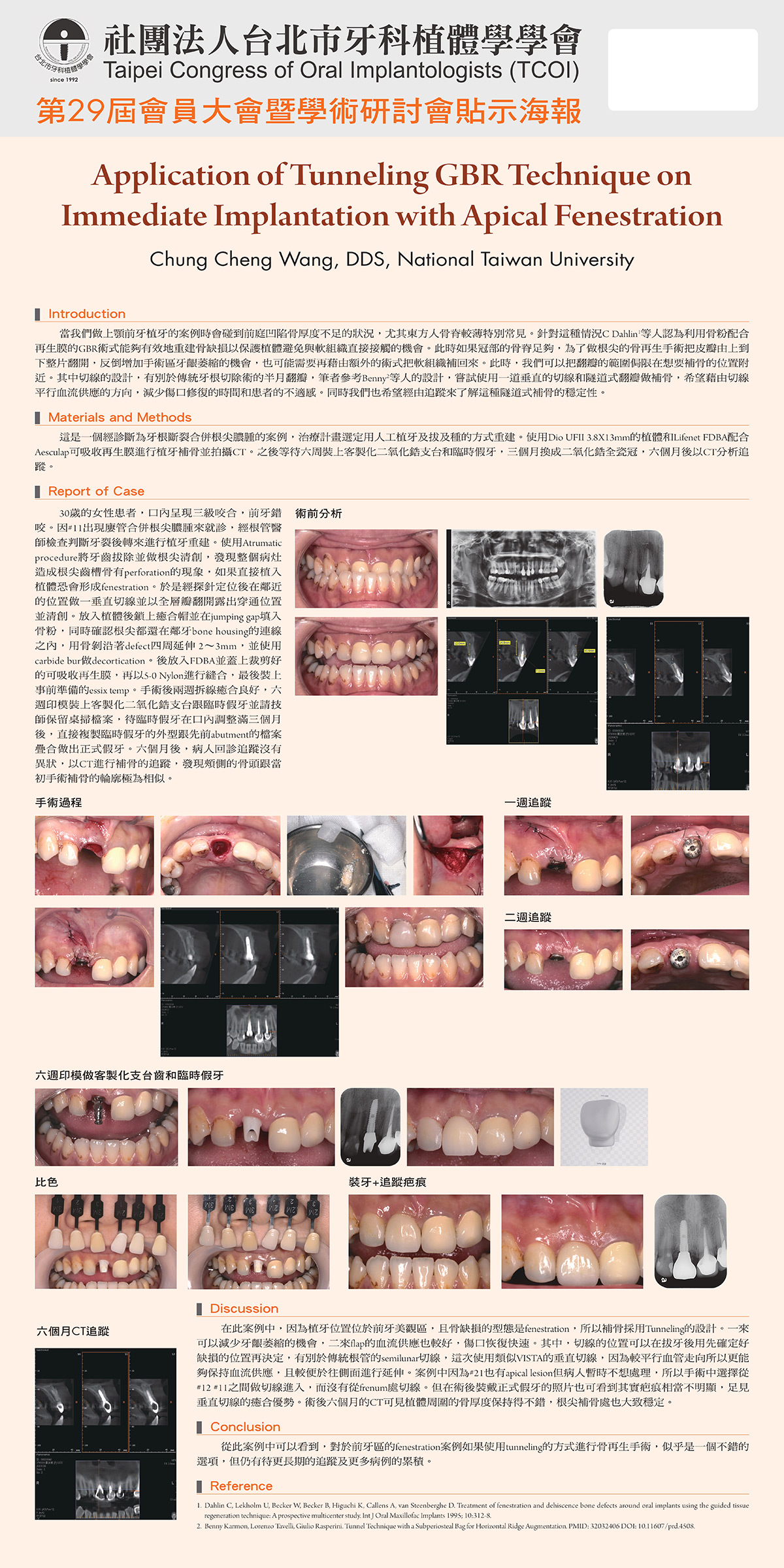 王崇丞醫師發表論文研究「隧道式GBR植牙技術應用」（Application of Tunneling GBR Techn
