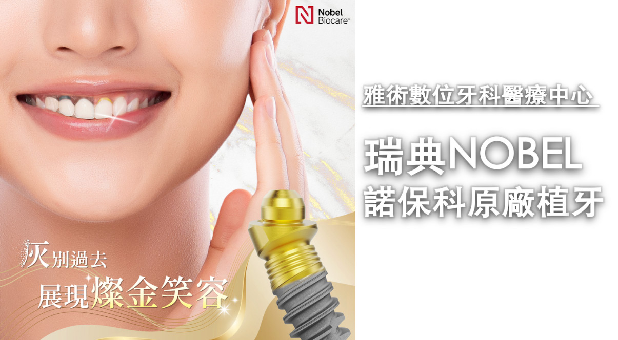 高規瑞典Nobel諾保科原廠植牙-1