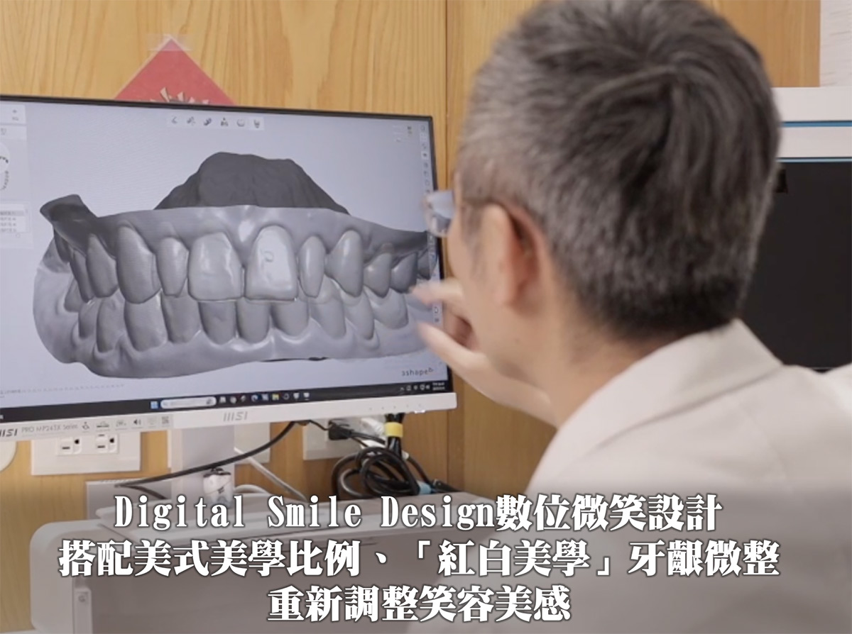 4D晶鑽前牙貼片_前牙美學｜美式美學、修飾牙齦比例