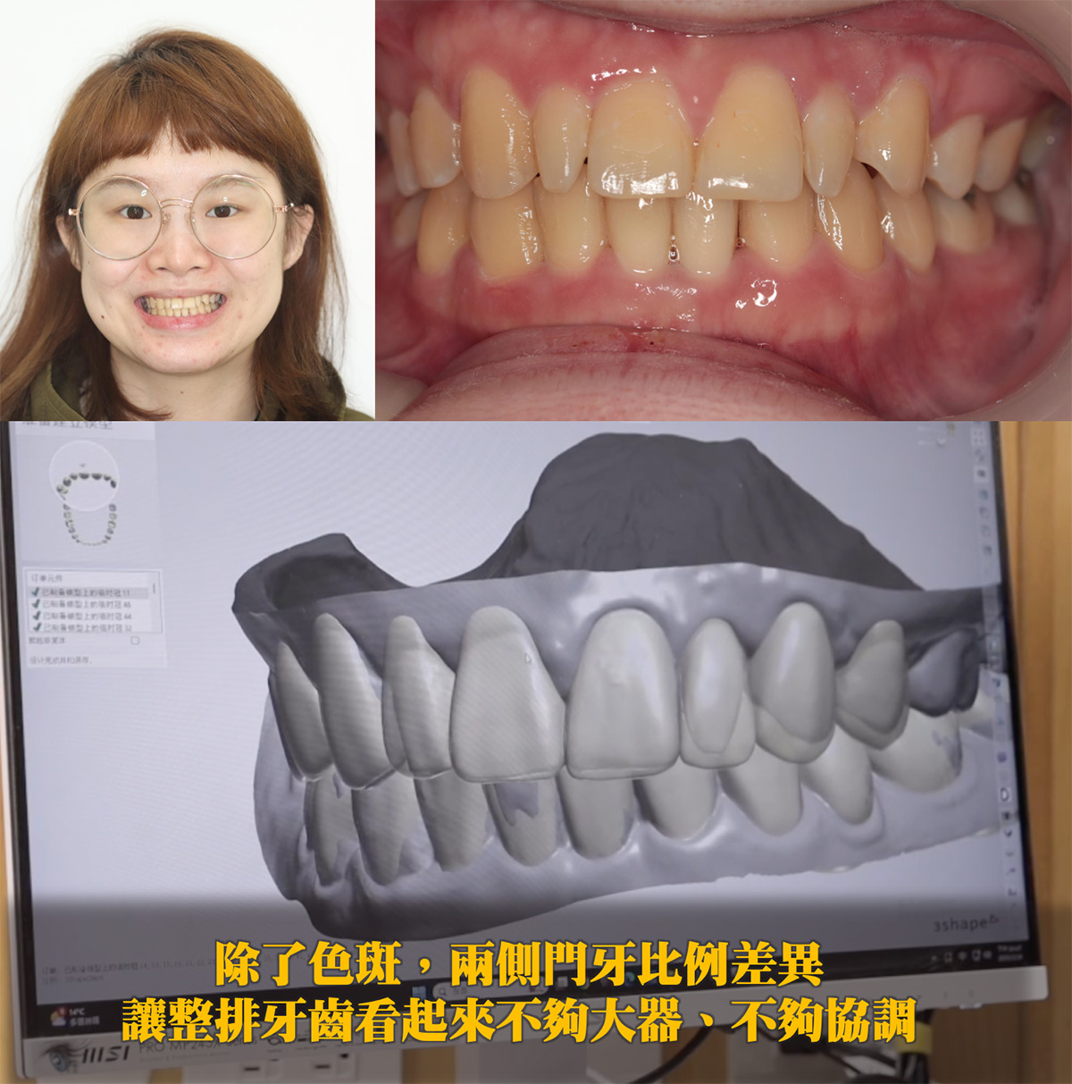 4D晶鑽前牙貼片｜前牙美學 數位牙科流程