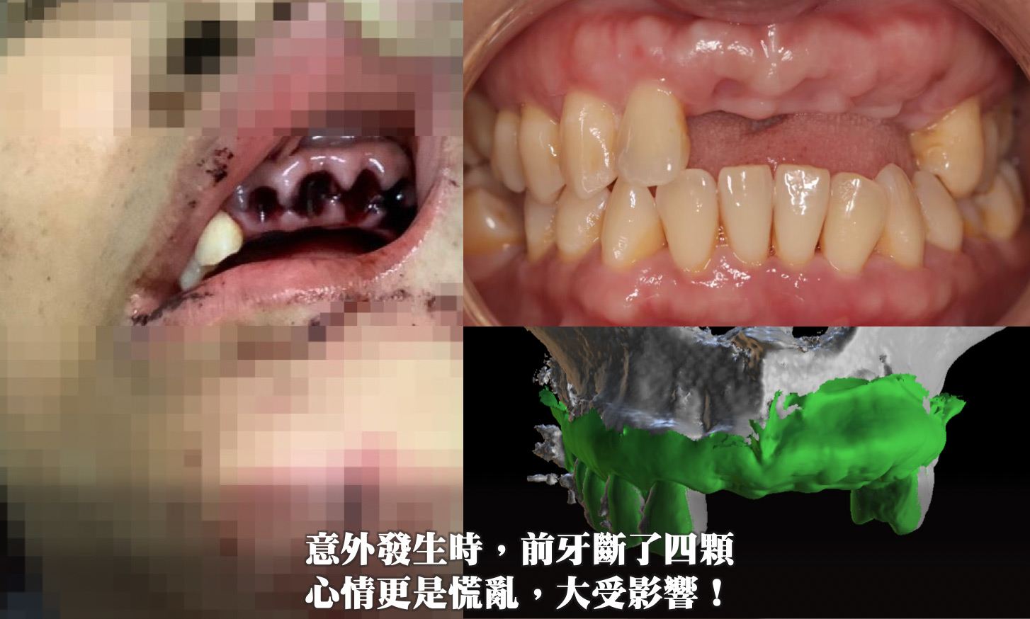 植牙案例｜顏面外傷與斷牙重建 ─ 沈育群醫師操刀高難度前牙植牙療程，展現精準植牙設計實力