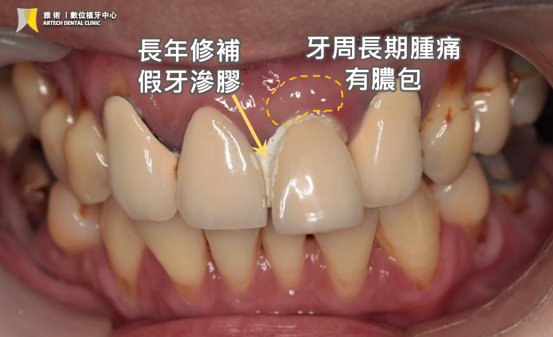 高難度植牙｜門牙爛根滲膠、牙肉腫痛，若是植牙失當的風險竟是牙齦塌陷！？3D水雷射微創植牙＋補骨＋補肉複合式治療，重拾健康