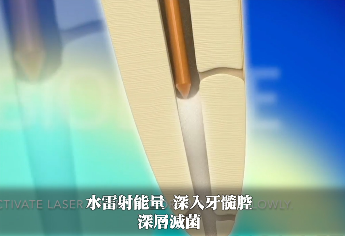 水雷射能量 深入牙髓腔深層滅菌