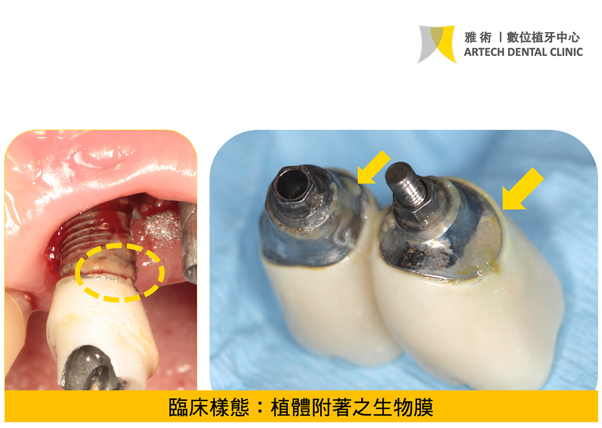 臨床樣態：植體附著之生物膜