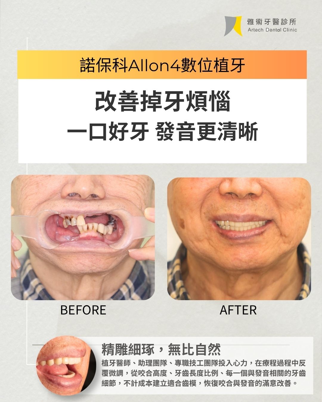 諾保科 All-on-4 植牙案例|改善掉牙,重拾清晰發音,回歸專業表現