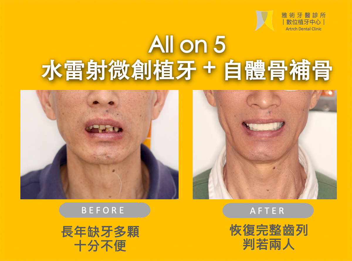 牙骨稀少也能全口植牙！Allon5水雷射微創植牙+自體骨補骨，重新擁有一口好牙！