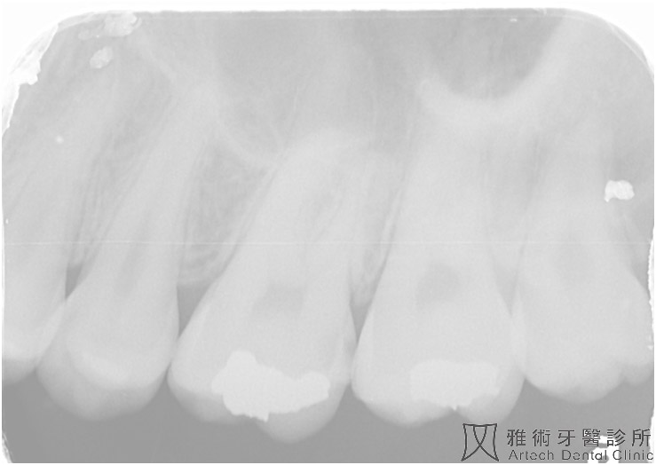 根尖片-2