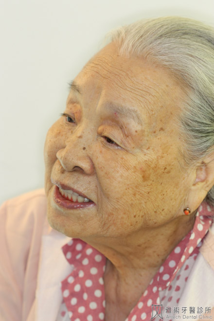 活動假牙14