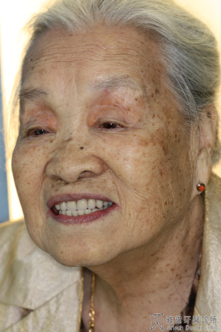 活動假牙15