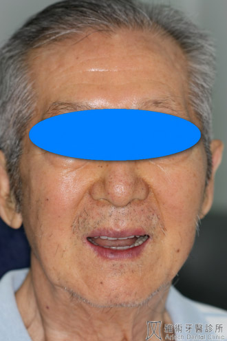 活動假牙8