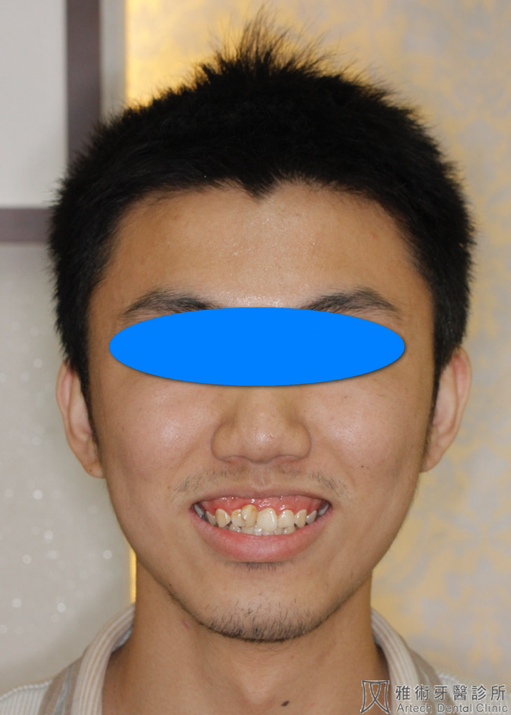 術前