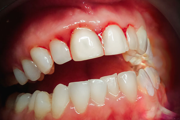 牙周病-1
