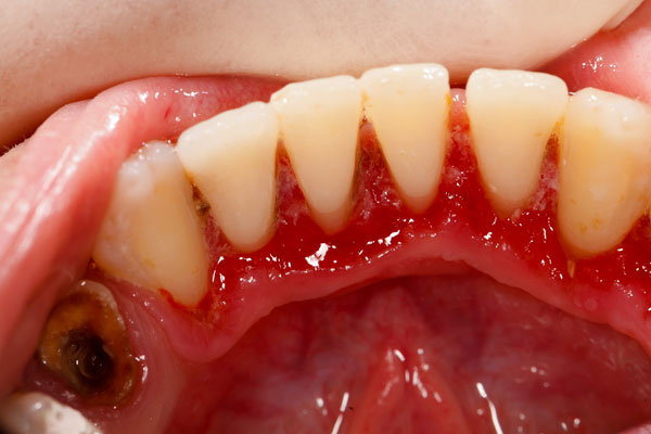 牙周病-2