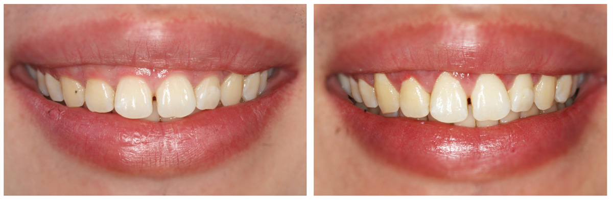 「齒齦雕塑美學」：齒齦修飾 開懷大笑更自在