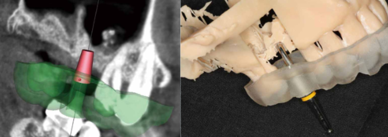 Transcrestal-sinus-floor-elevation-with-a-minimally-invasive-technique.Using-surgical-guide-1