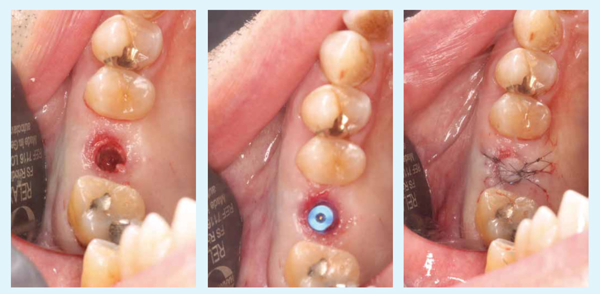 Transcrestal-sinus-floor-elevation-with-a-minimally-invasive-technique.Using-surgical-guide