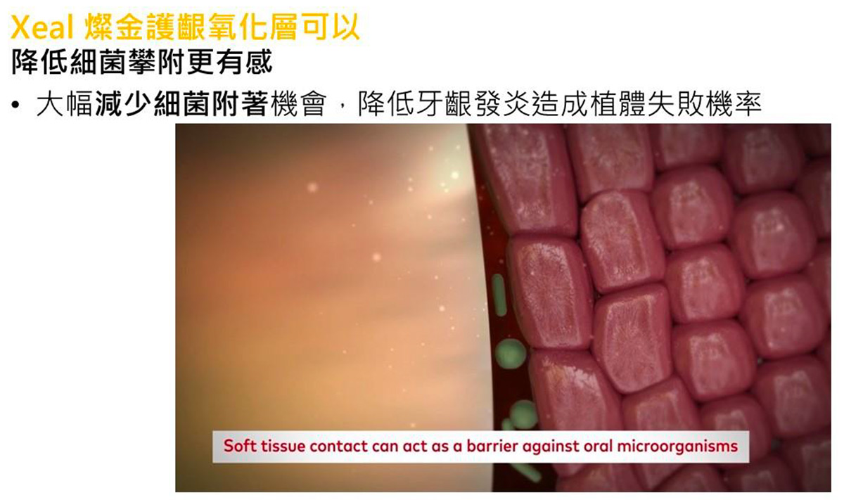 高規瑞典Nobel諾保科原廠植牙-2