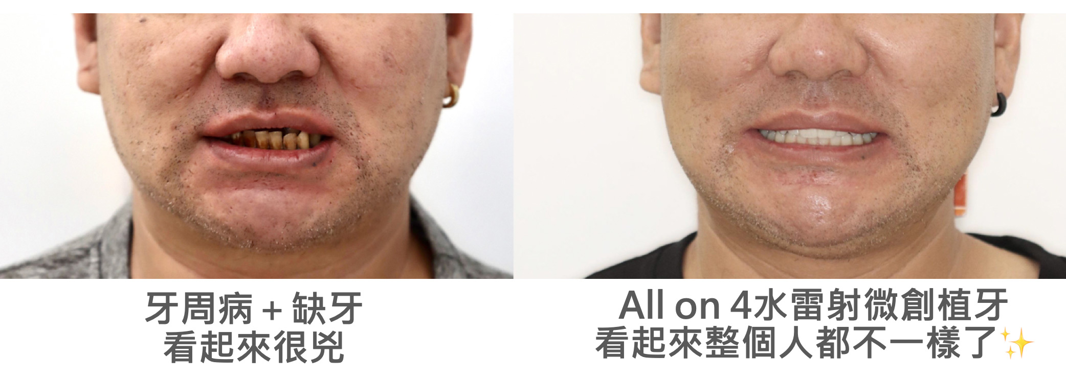 中年牙周病