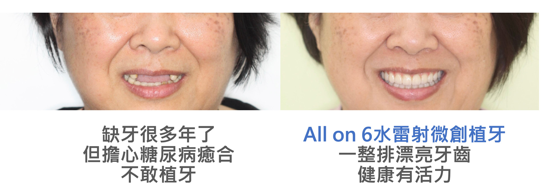 多年糖尿病+服用抗凝血劑:All on 4 水雷射微創植牙 安心免煩惱