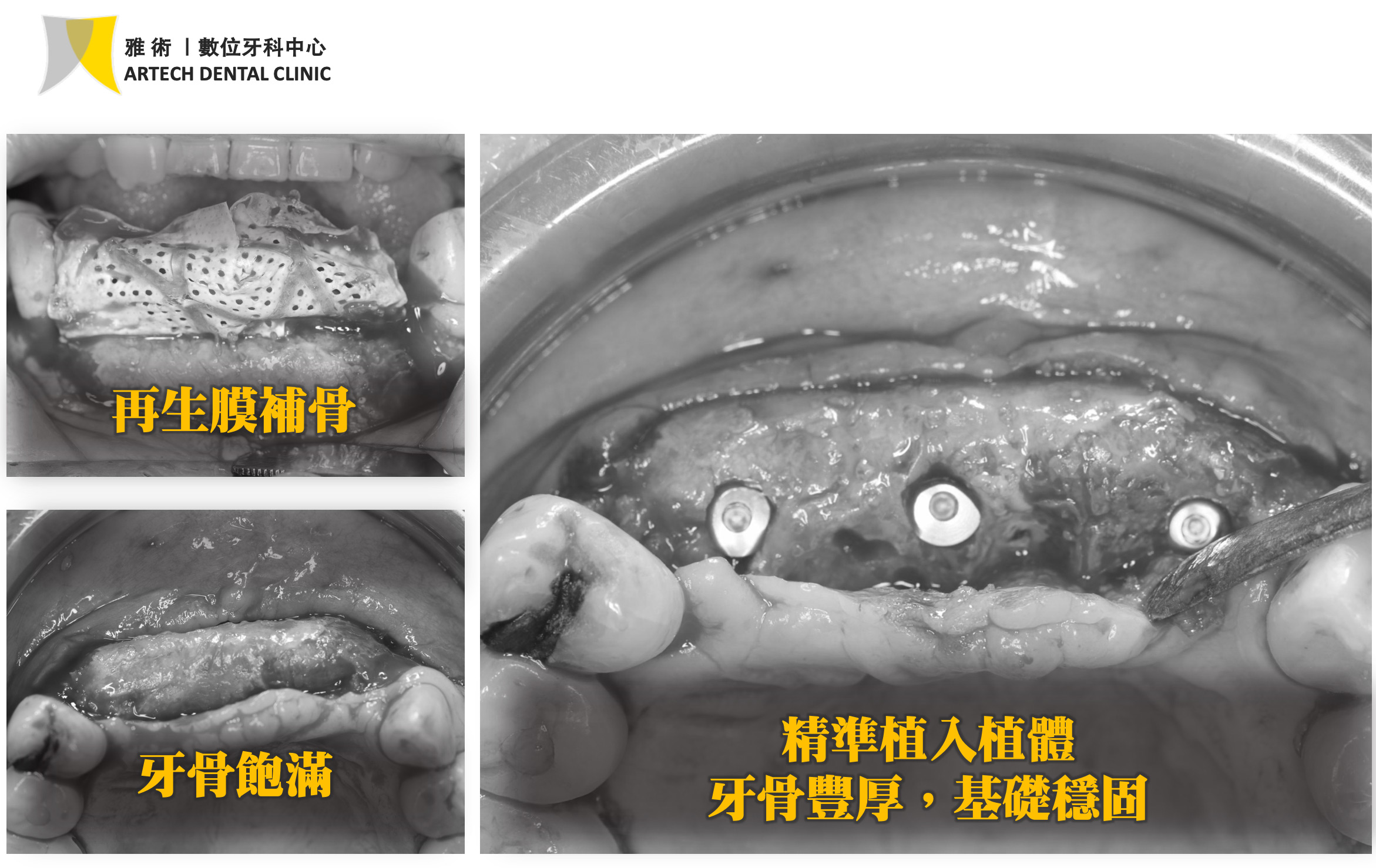 再生膜補骨