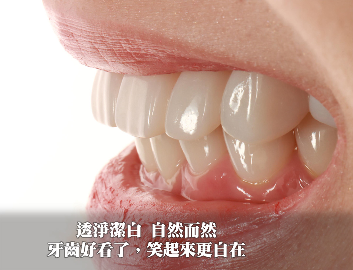 4D晶鑽前牙貼片|前牙美學 牙齒變好看