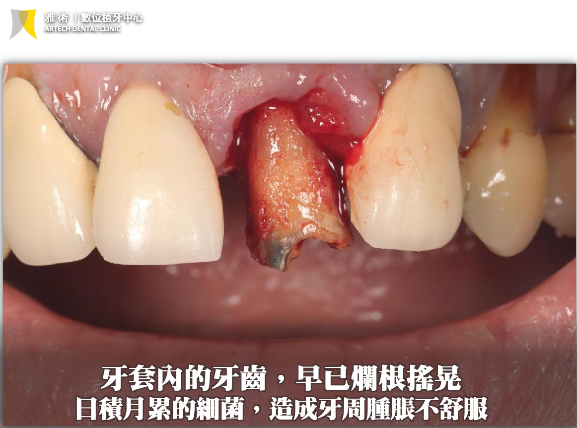 日積月累的細菌，造成牙周腫脹不舒服