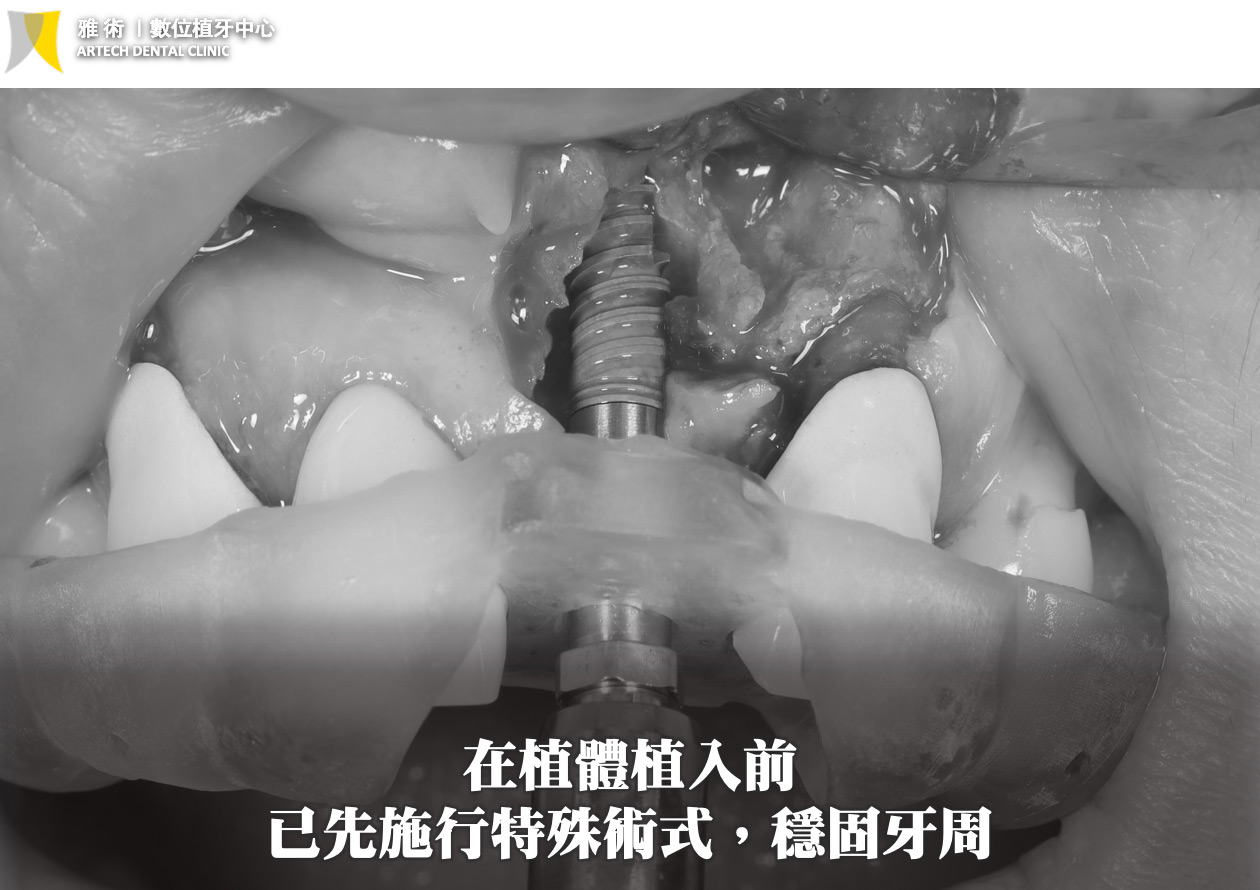植牙前已先施行特殊術式，穩固牙周