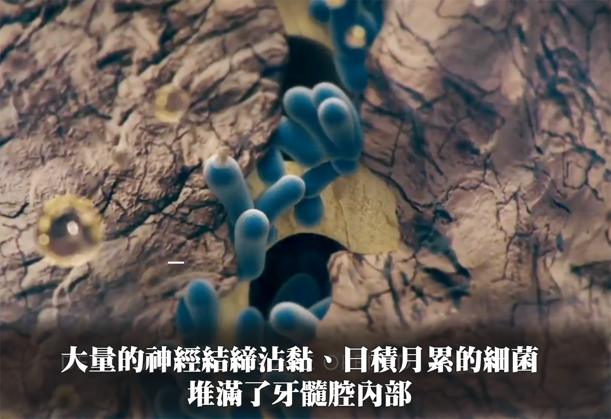 大量的神經結締沾黏、日積月累的細菌 堆滿了牙髓腔內部