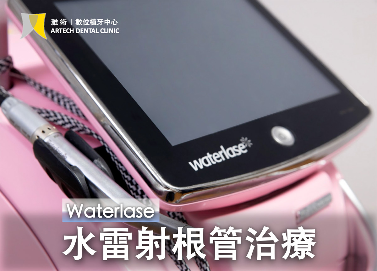 水雷射根管治療BAnner