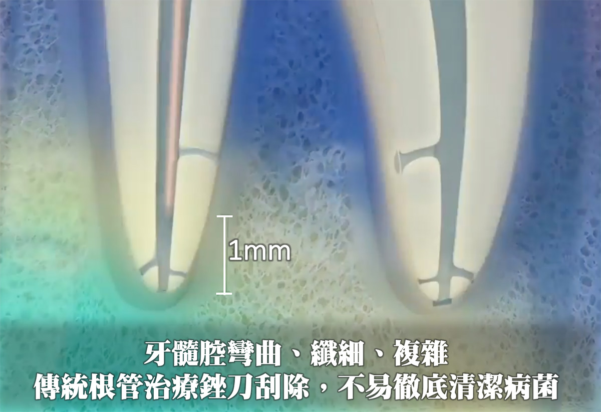 傳統根管治療銼刀刮除，不易徹底清潔病菌
