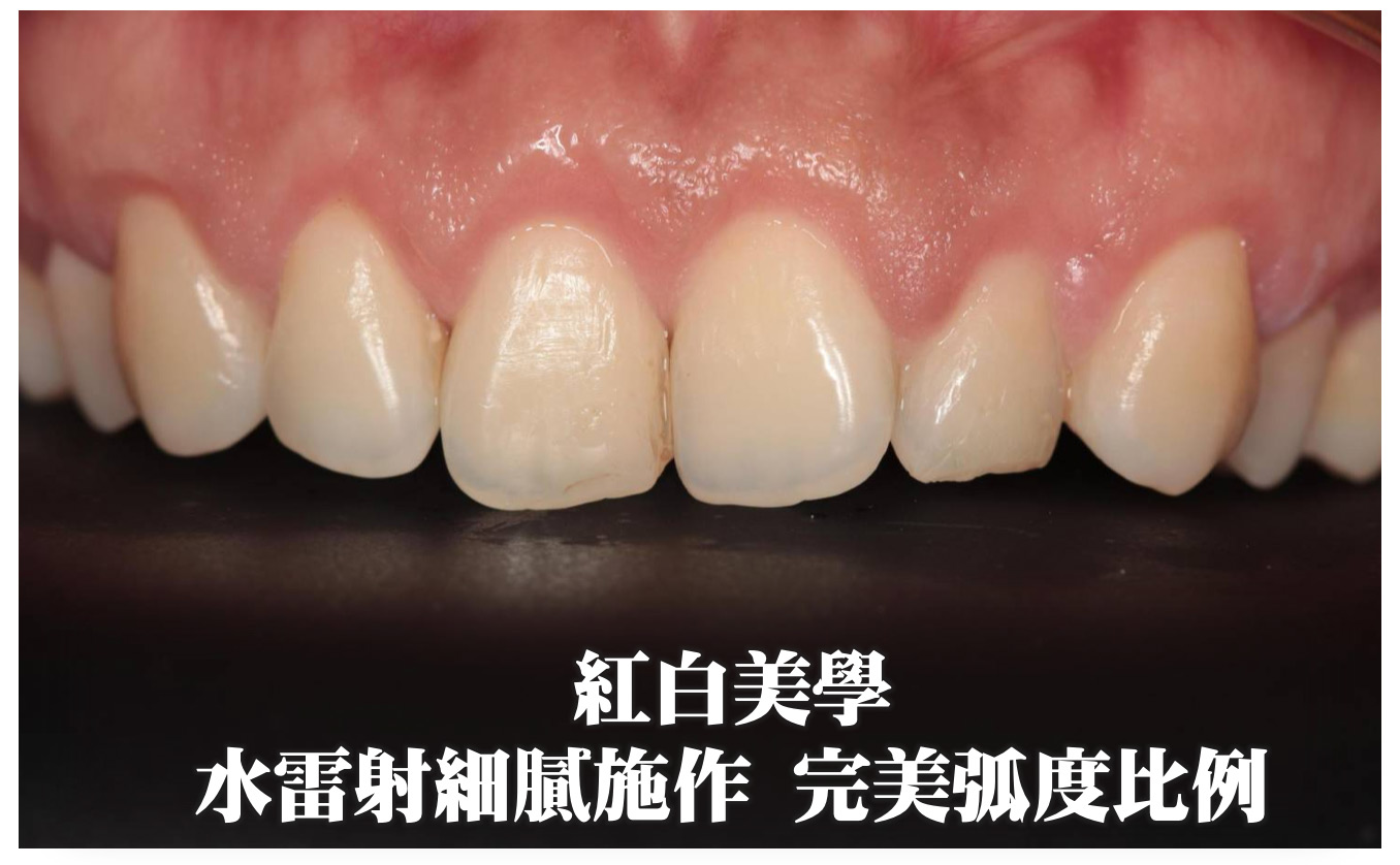 水雷射細膩施作 完美弧度比例