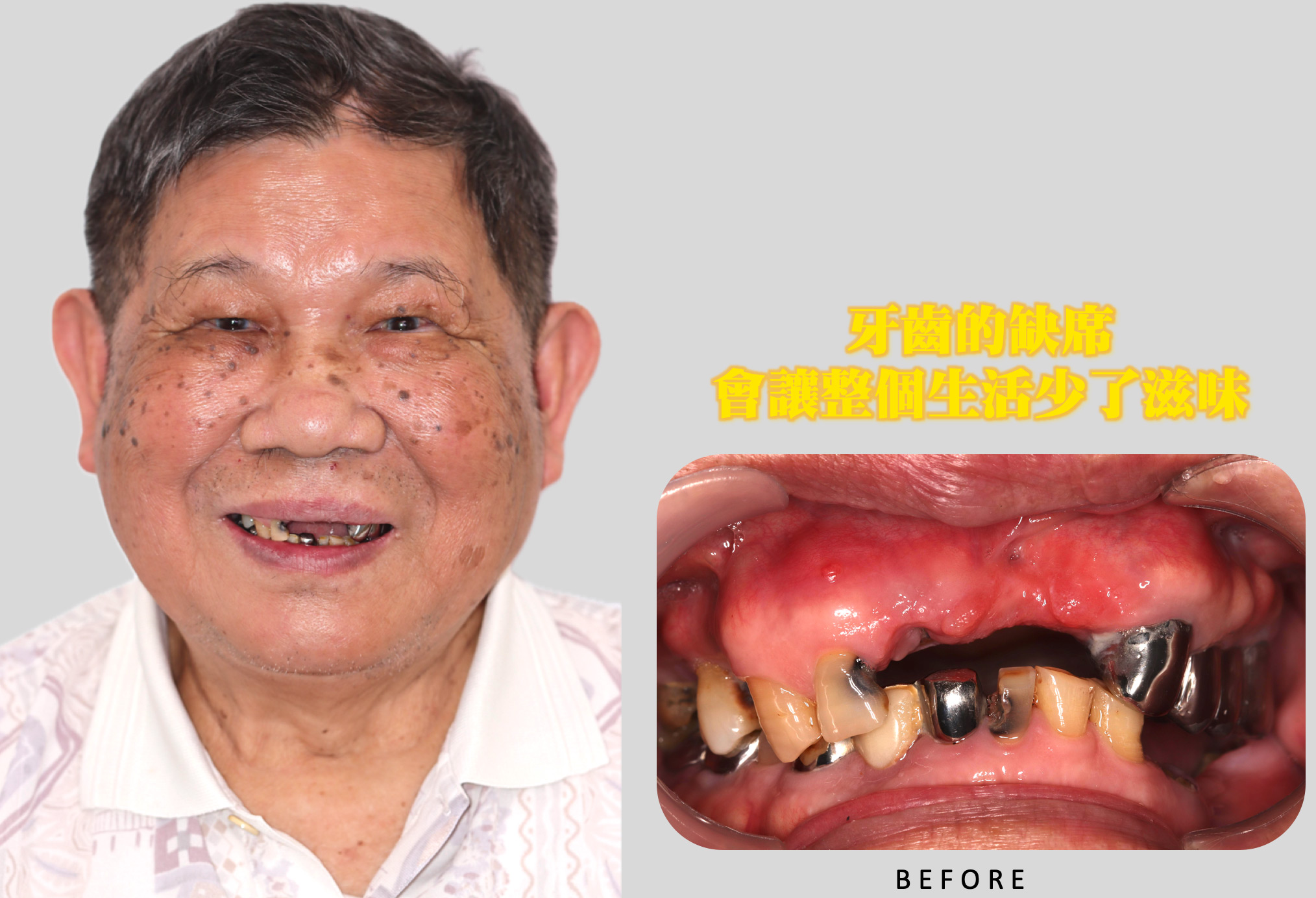 牙齒的缺席會讓整個生活少了滋味