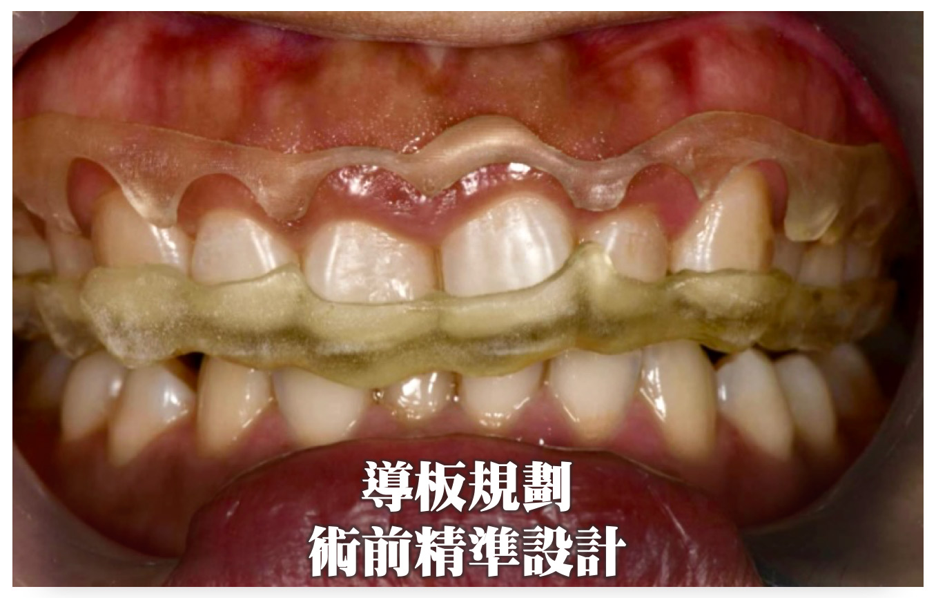 術前精準設計