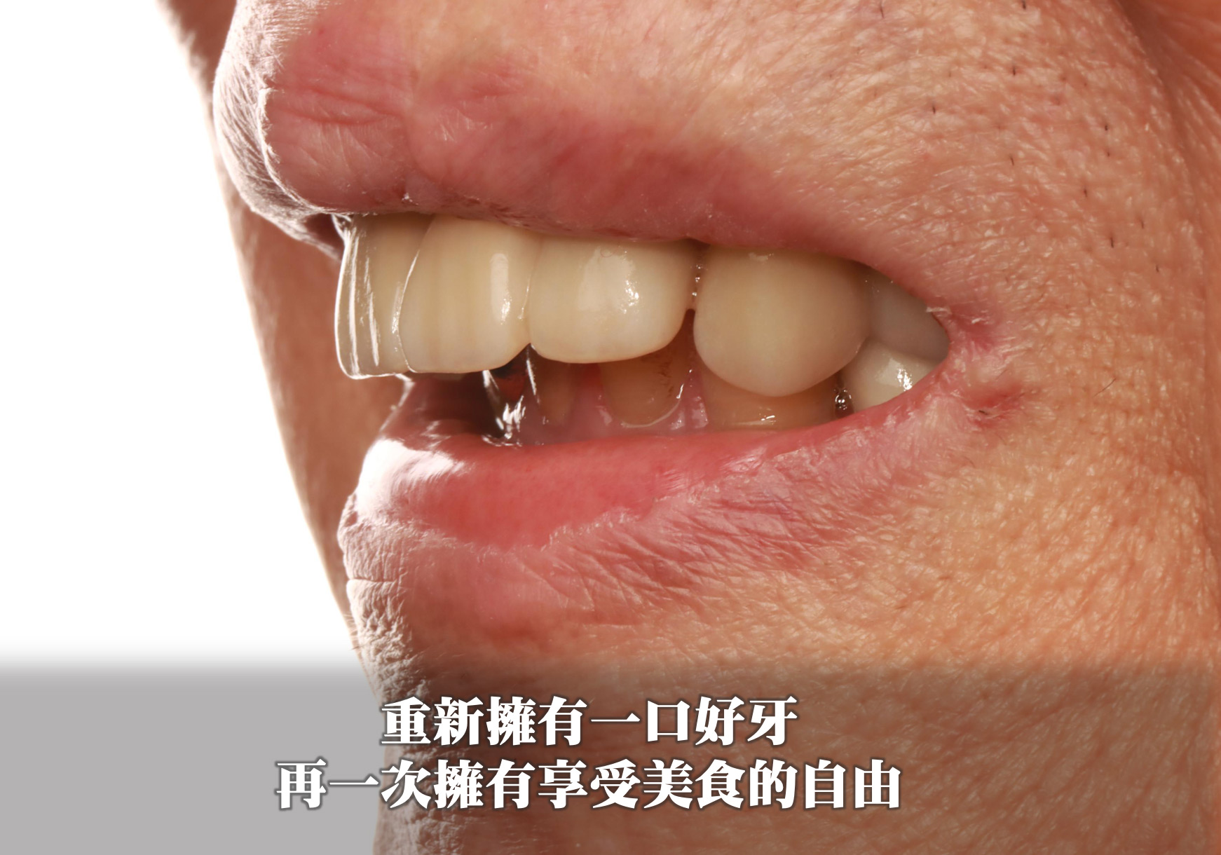 重新擁有一口好牙 再一次擁有享受美食的自由