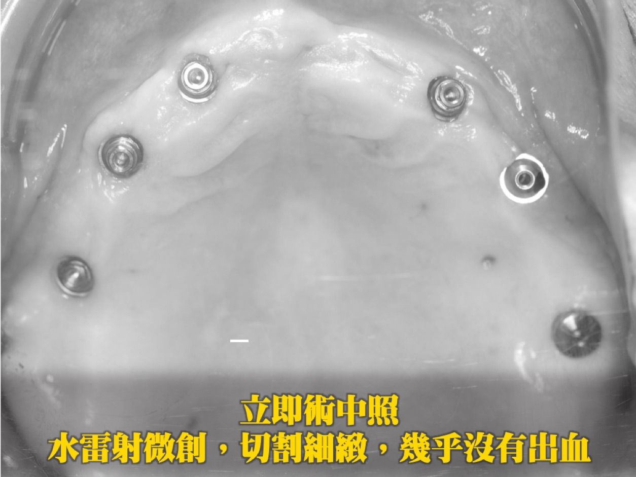 立即術中照