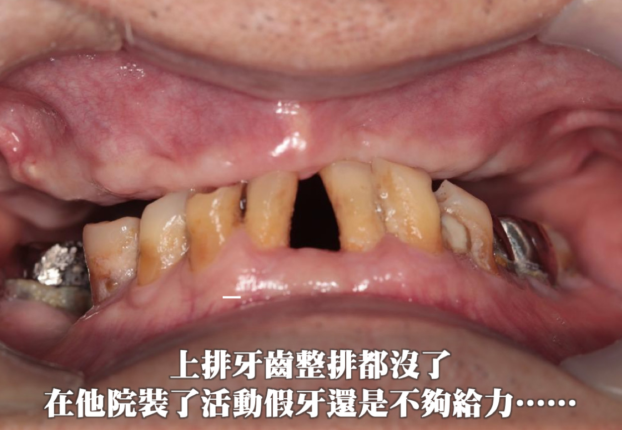 他院假牙不給力