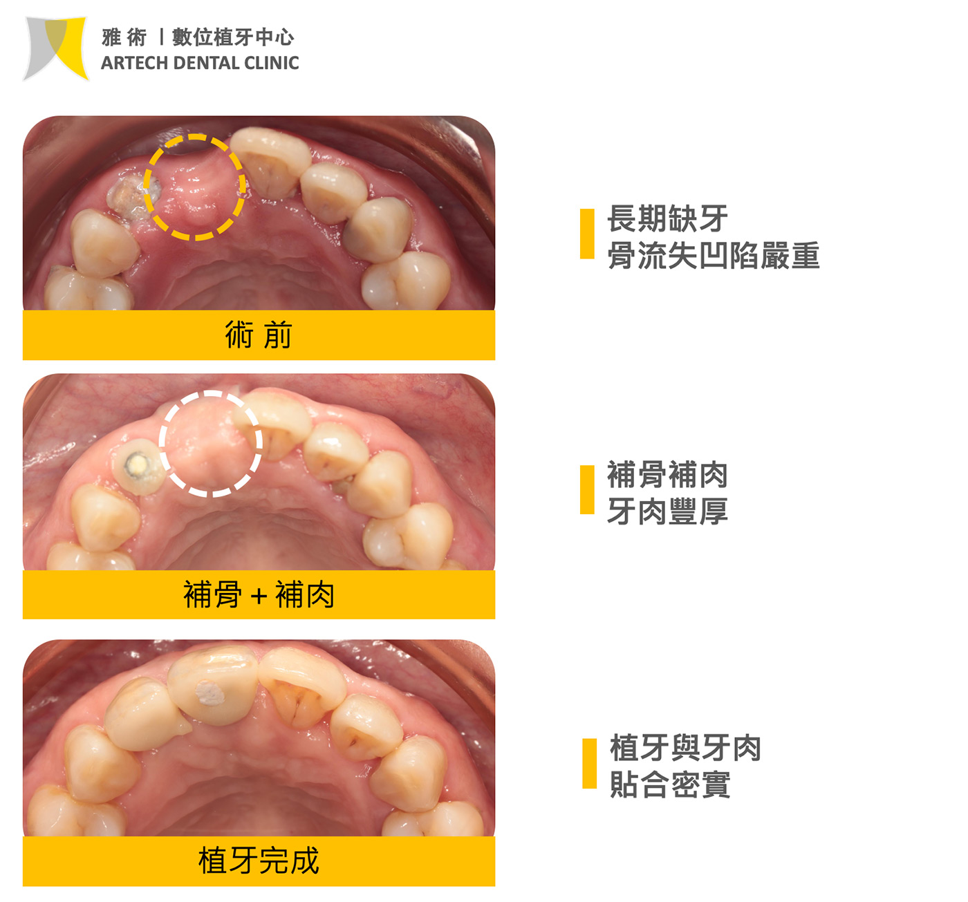 先進行補骨與補肉的處理，並且從患者口腔就地取材，重建骨質與牙齦的厚度。術後可以明顯看到牙齦組織變得飽滿且穩定