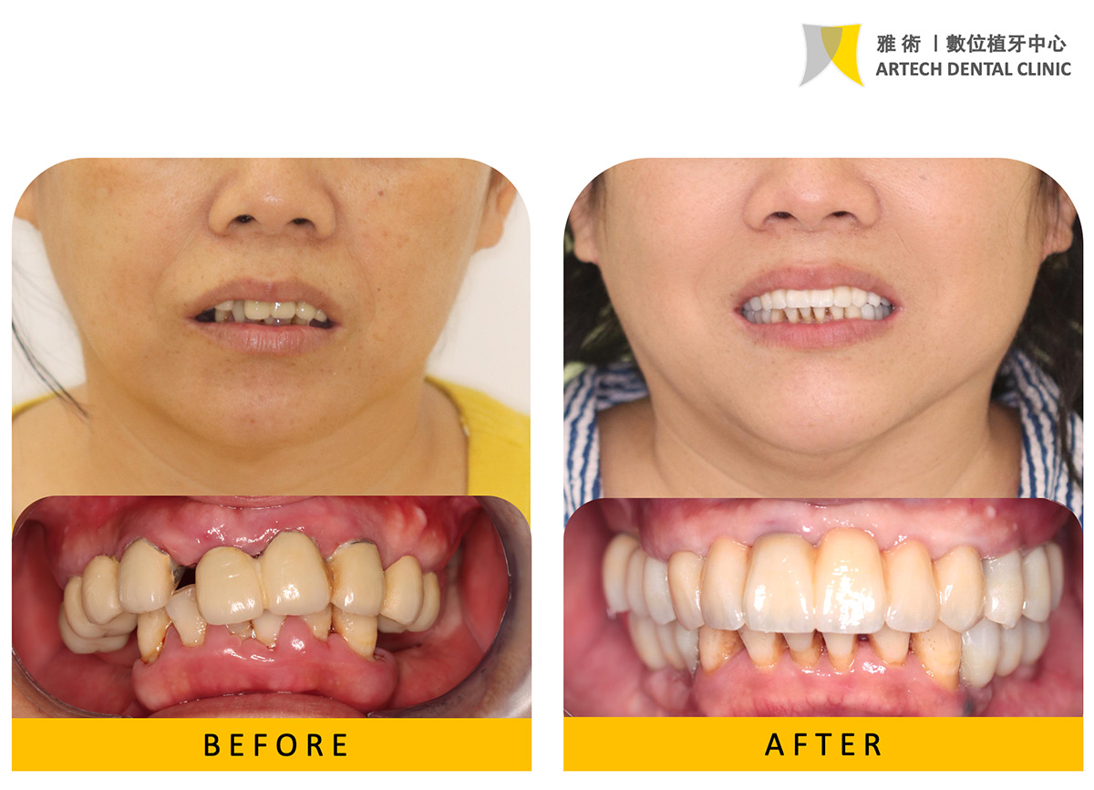 患者由於長期缺牙臉頰凹陷