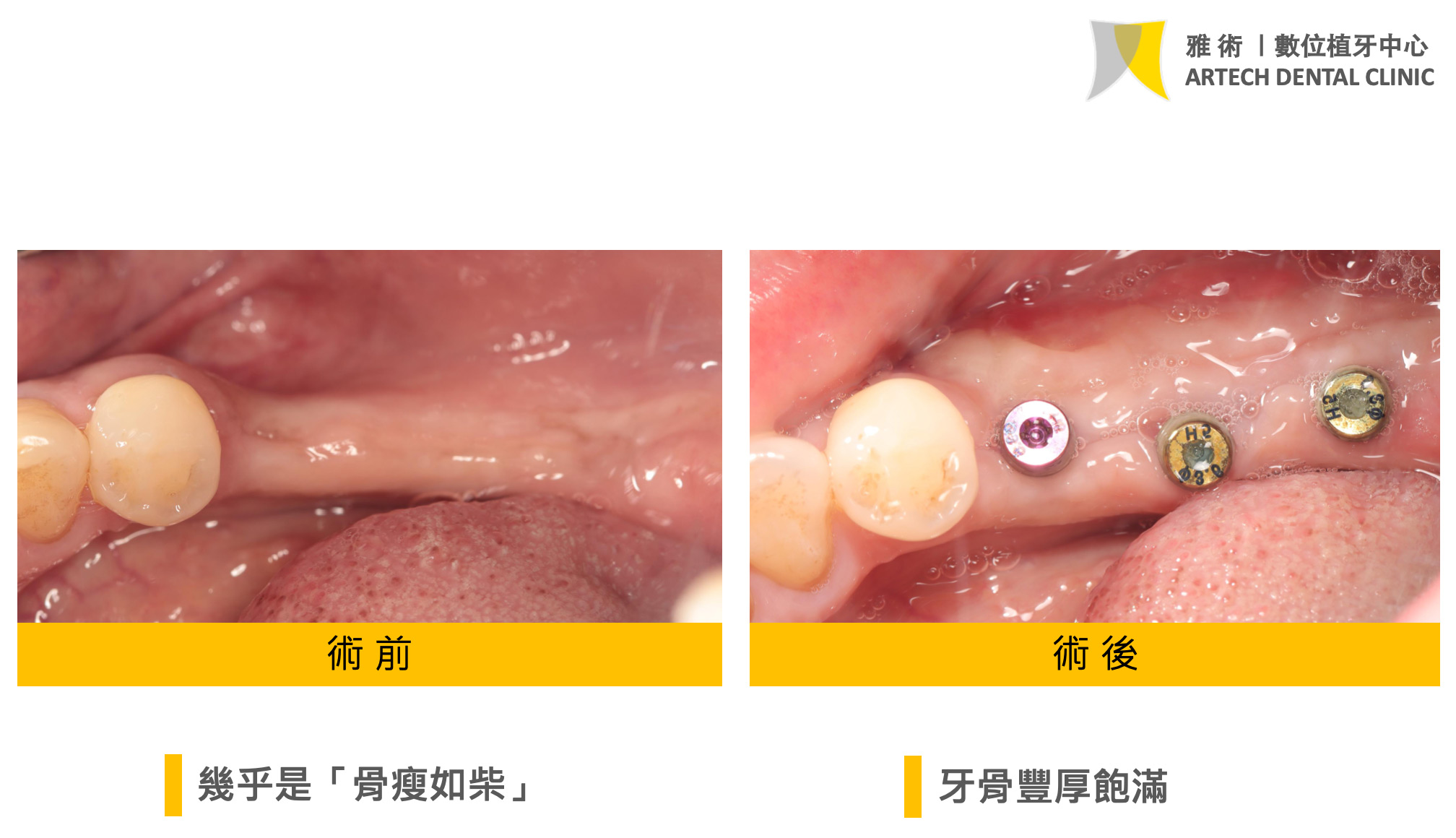 此案例因長期缺牙導致骨量嚴重萎縮,牙槽骨變得狹窄脆弱,已不適合直接植牙。 (1)