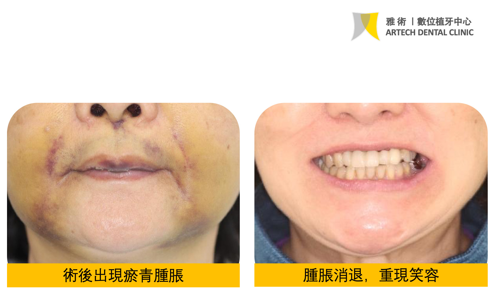 雅術|術後腫脹消退不需擔心