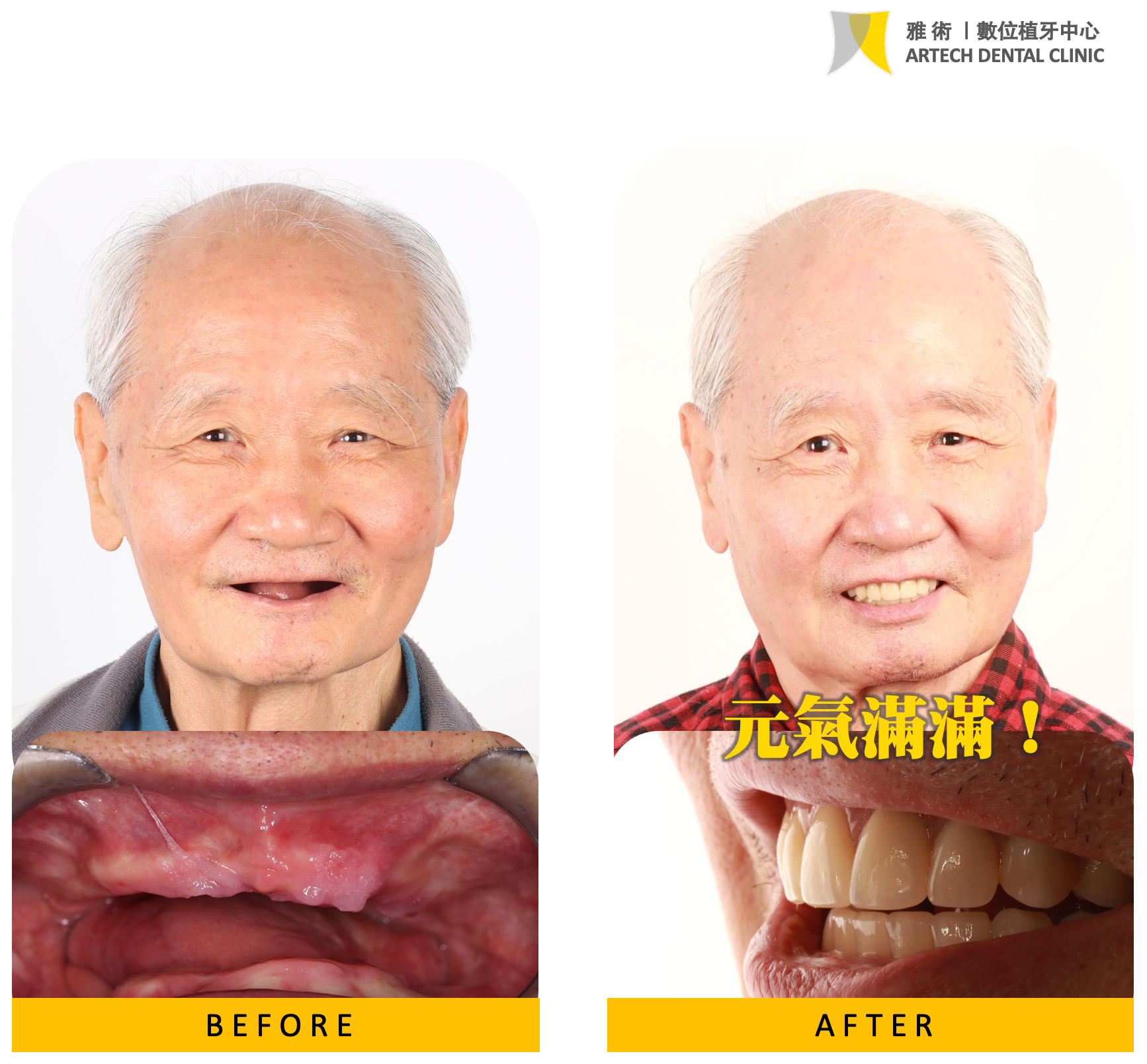 從臨床經驗來說，不論是活動假牙、牙橋還是植牙，並沒有絕對的「最好」，