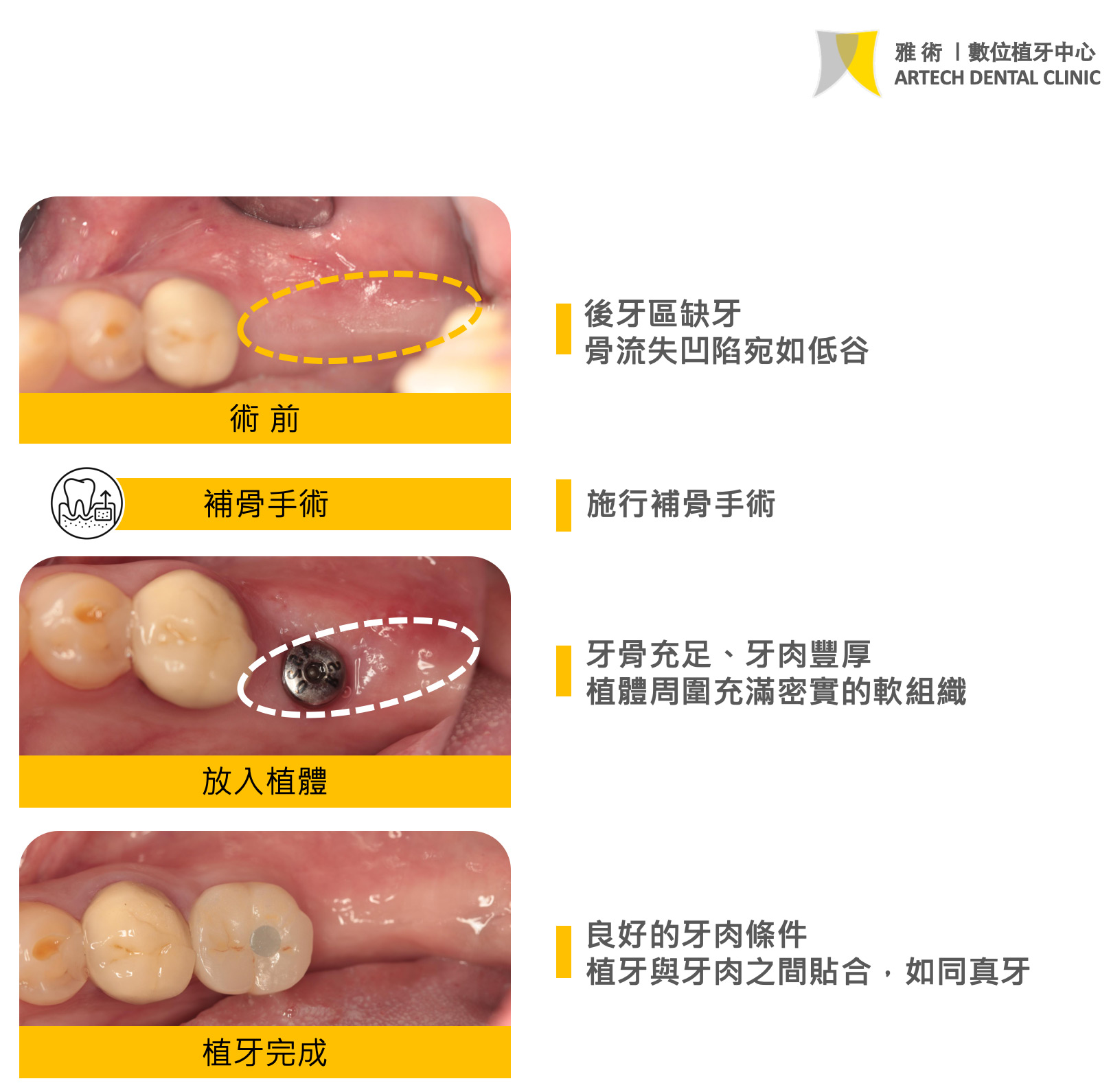 這位患者在手術前，因為後牙區域長期缺牙，導致齒槽骨逐漸吸收流失，形成明顯的凹陷，就像是一個低谷
