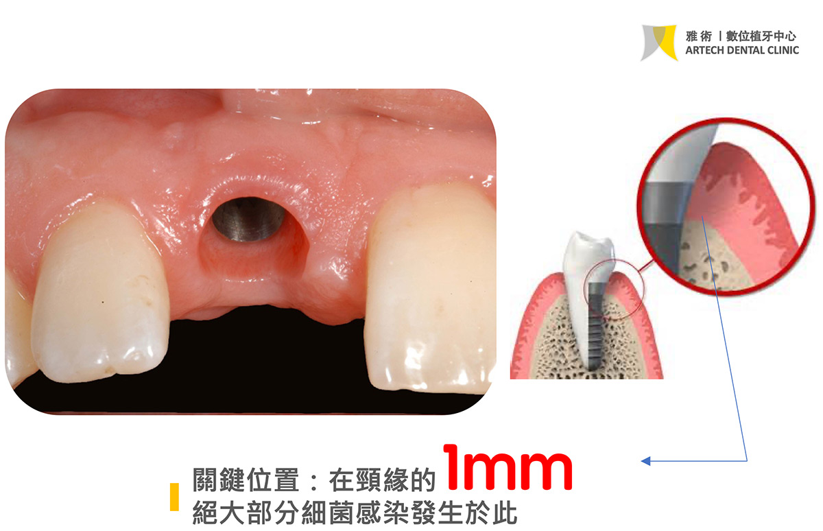 牙菌斑聚集位置