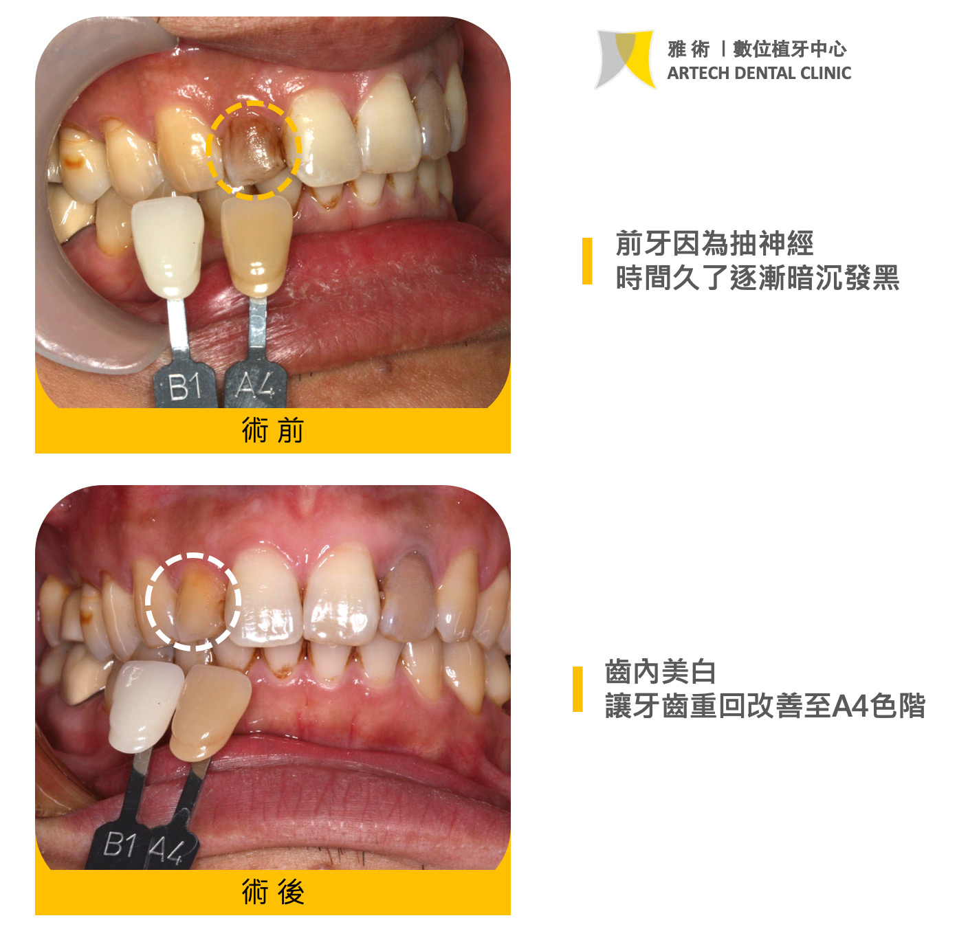 齒內美白 改變