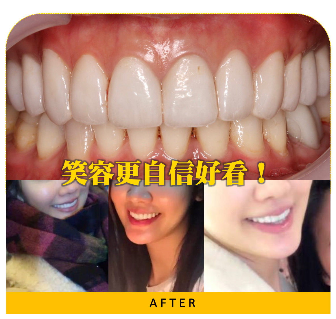齒內美白after