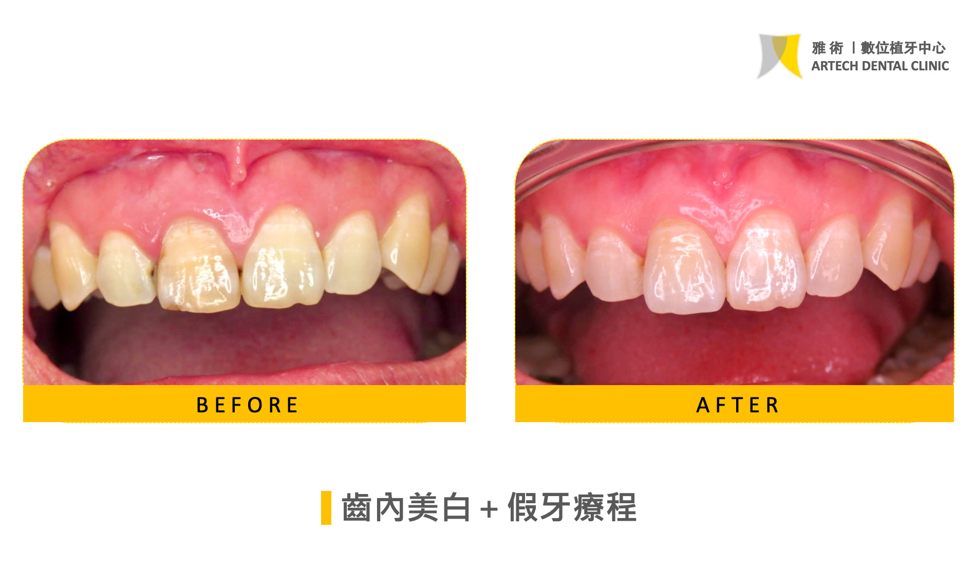 齒內美白＋假牙