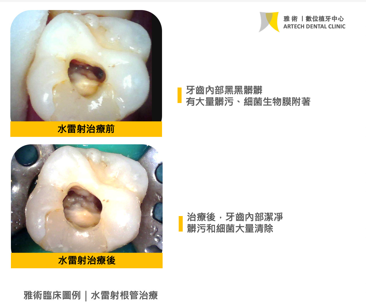 雅術水雷射治療臨床案例|根管治療