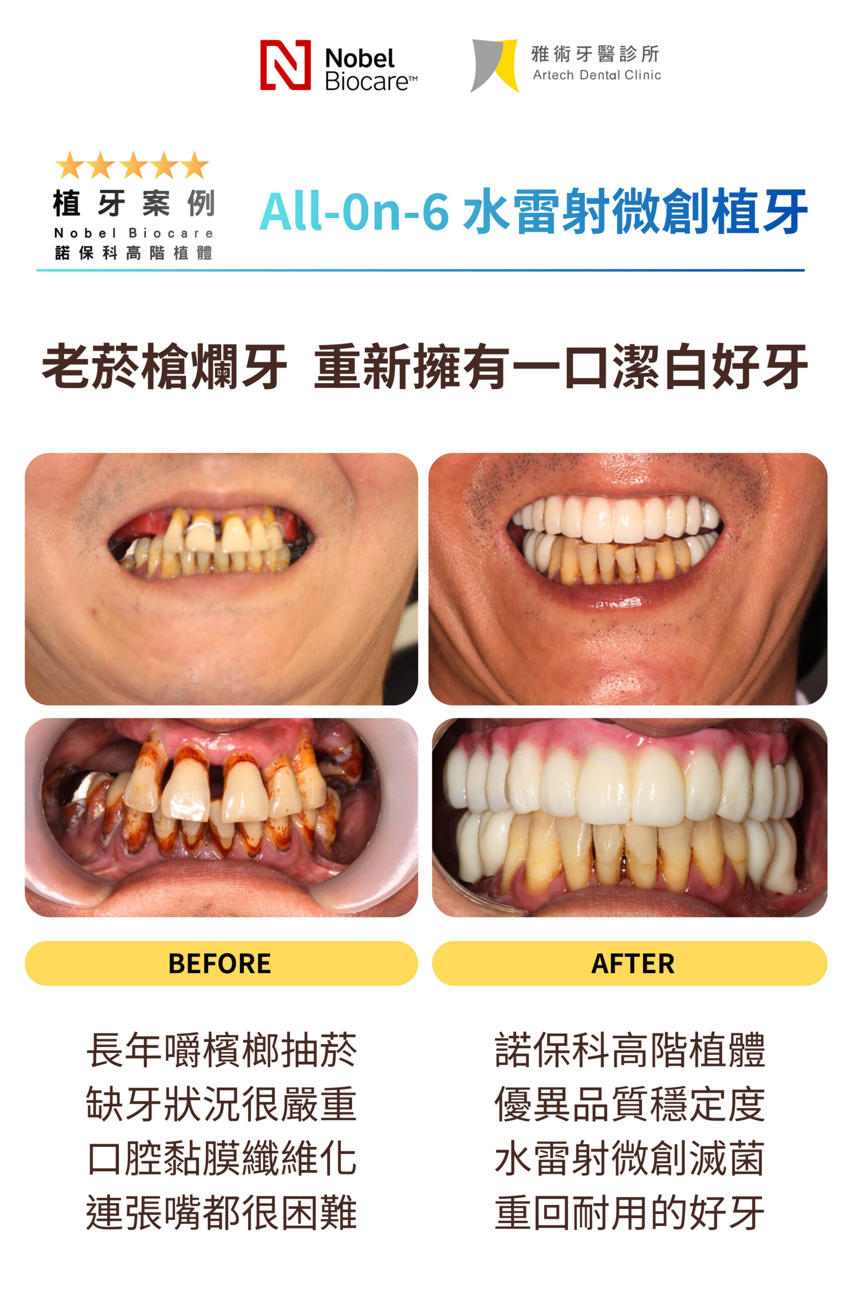 老菸槍爛牙 重新擁有一口潔白好牙